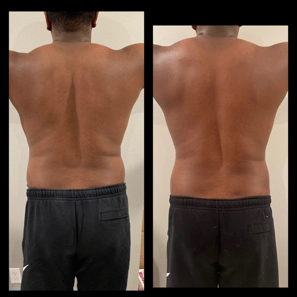 Cryosculpting Machine - Picture 9 of 12